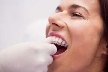 Îmbunătățirea esteticii dentare cu ajutorul aparatului dentar invizibil