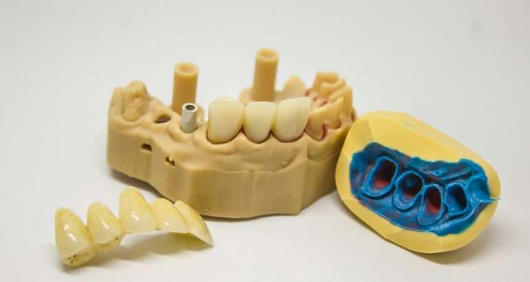 În ce situații implantul dentar este cea mai bună soluție de restaurare?