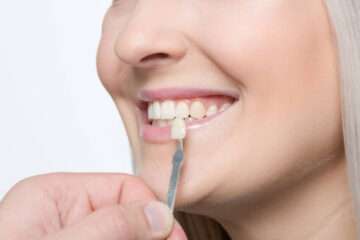 Secretul unui zâmbet perfect: Fațetele dentare și avantajele lor estetice și funcționale